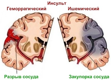 Инсульт различия. Ишемический и геморрагический инсульт разница. Типы ишемического инсульта. Геморрагический инсульт от ишемического.
